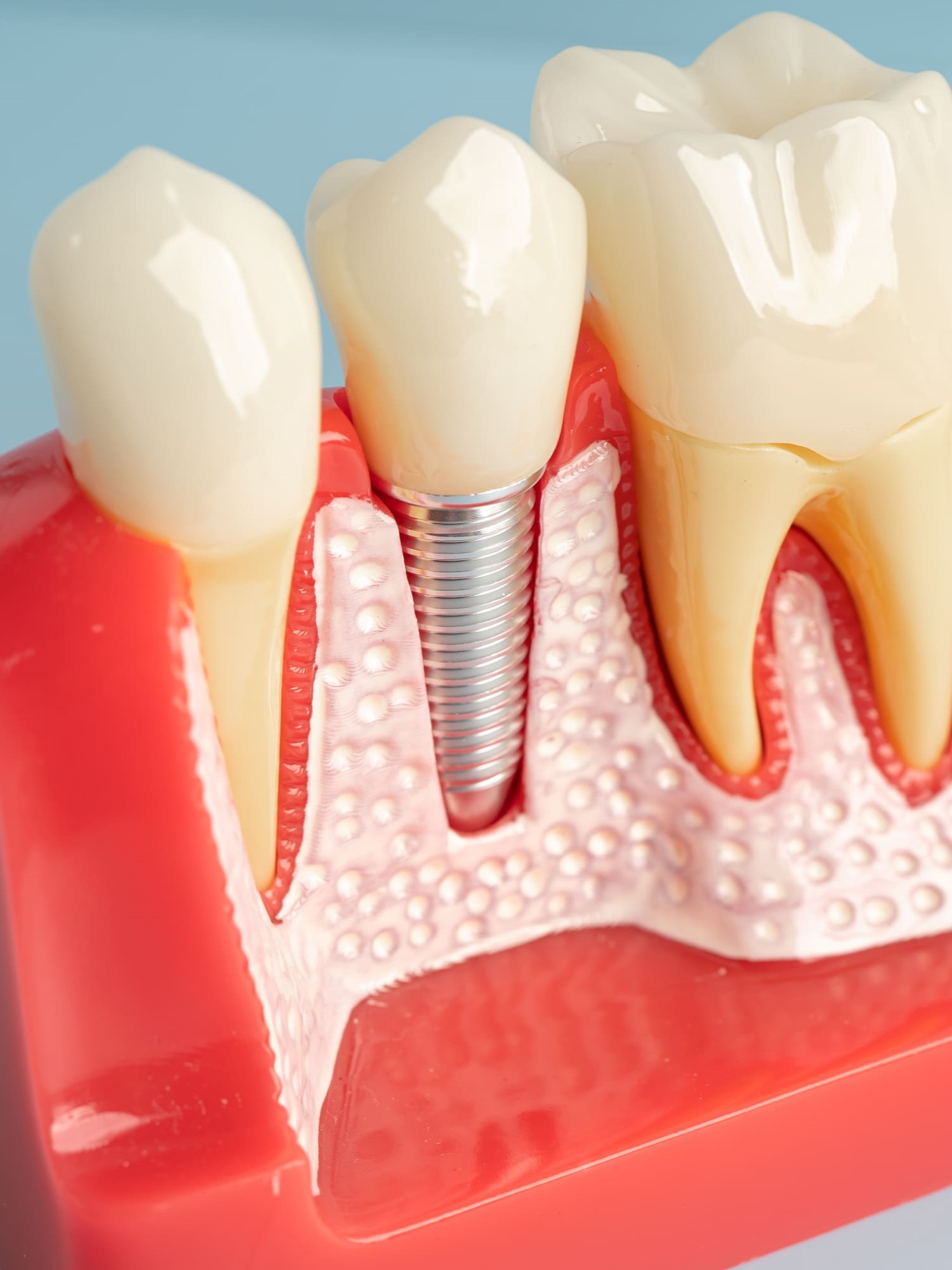 implantes